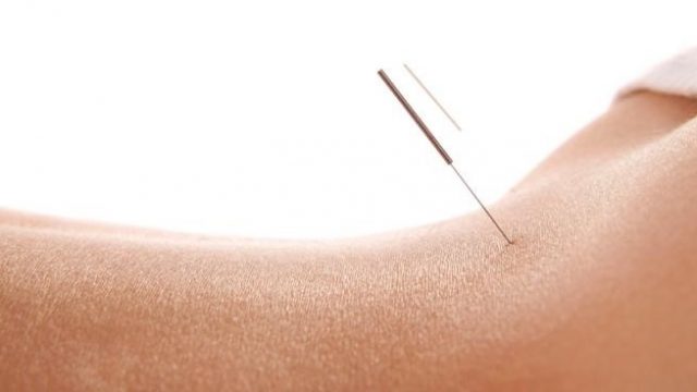 ACUPUNTURA OU FÁRMACOS? ABORDAGENS DIFERENTES QUE SE COMPLEMENTAM.