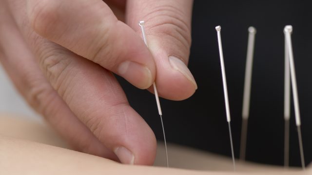 OS BENEFÍCIOS DA ACUPUNTURA
