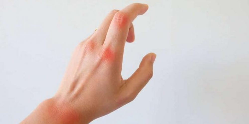 A ALIMENTAÇÃO NA ARTRITE